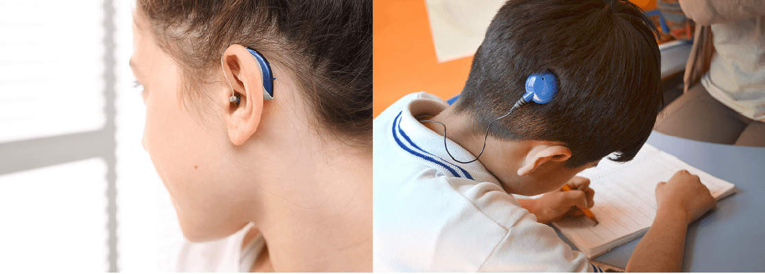 Difference Between Cochlear Implants and Hearing Aids