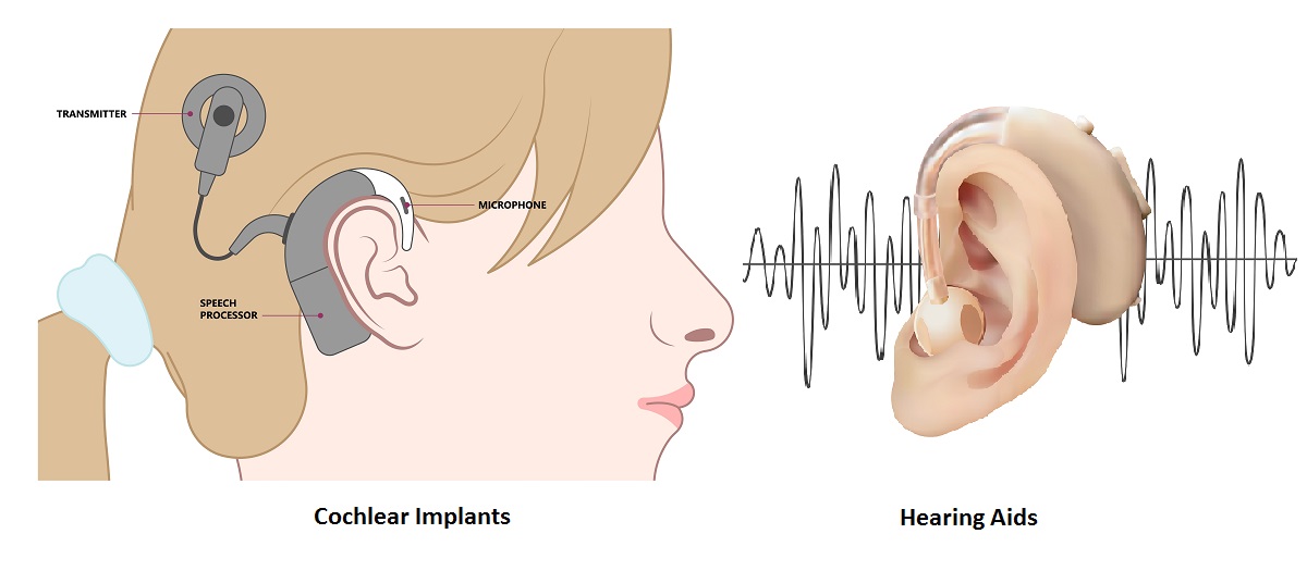 Cochlear implants vs hearing aids